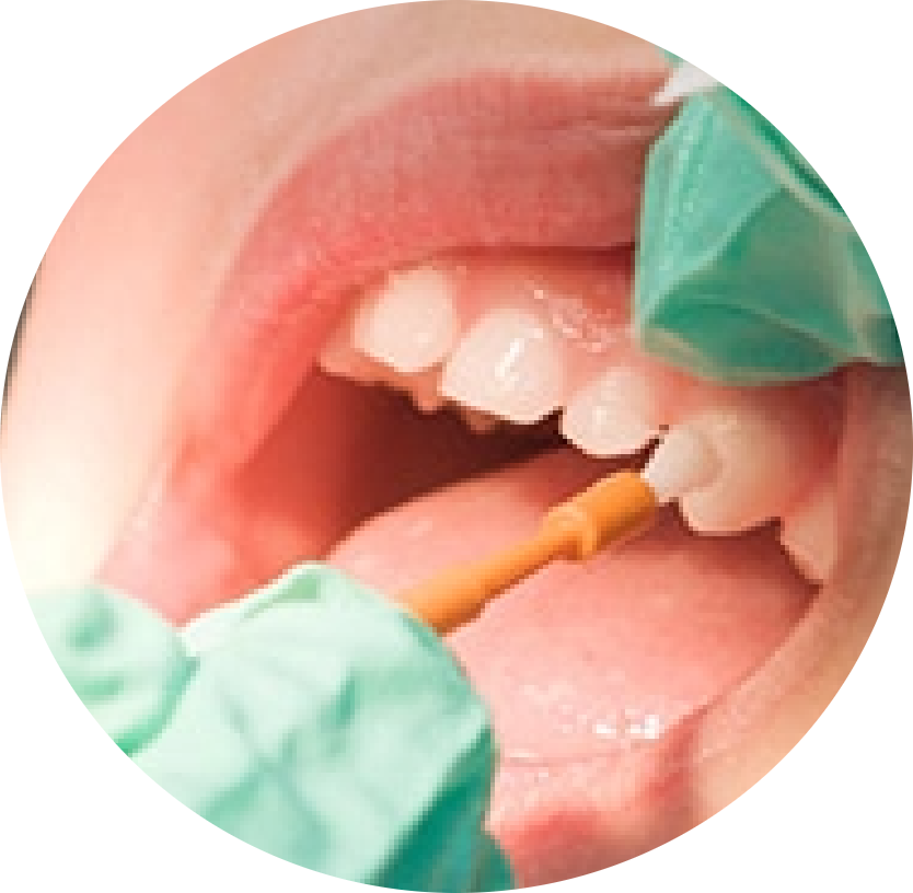 fluoride-for-teeth