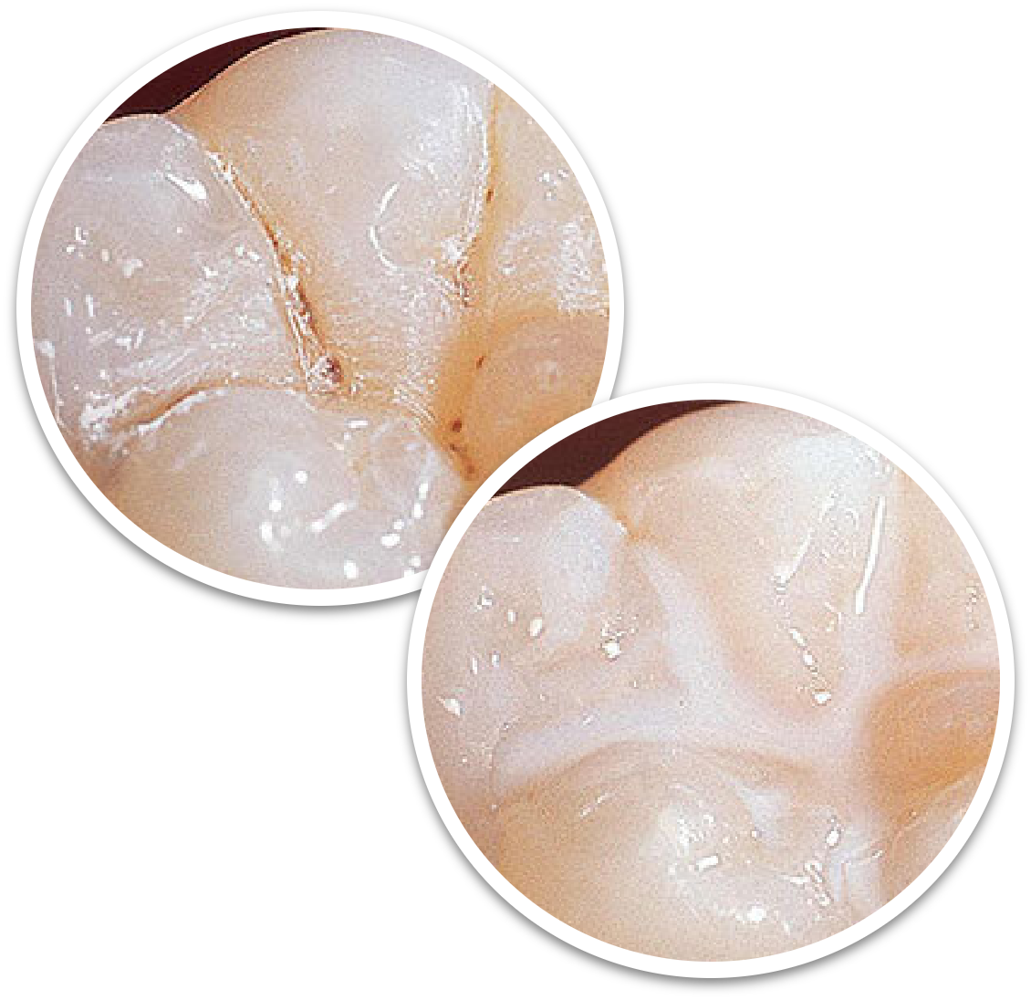 sealants-for-teeth