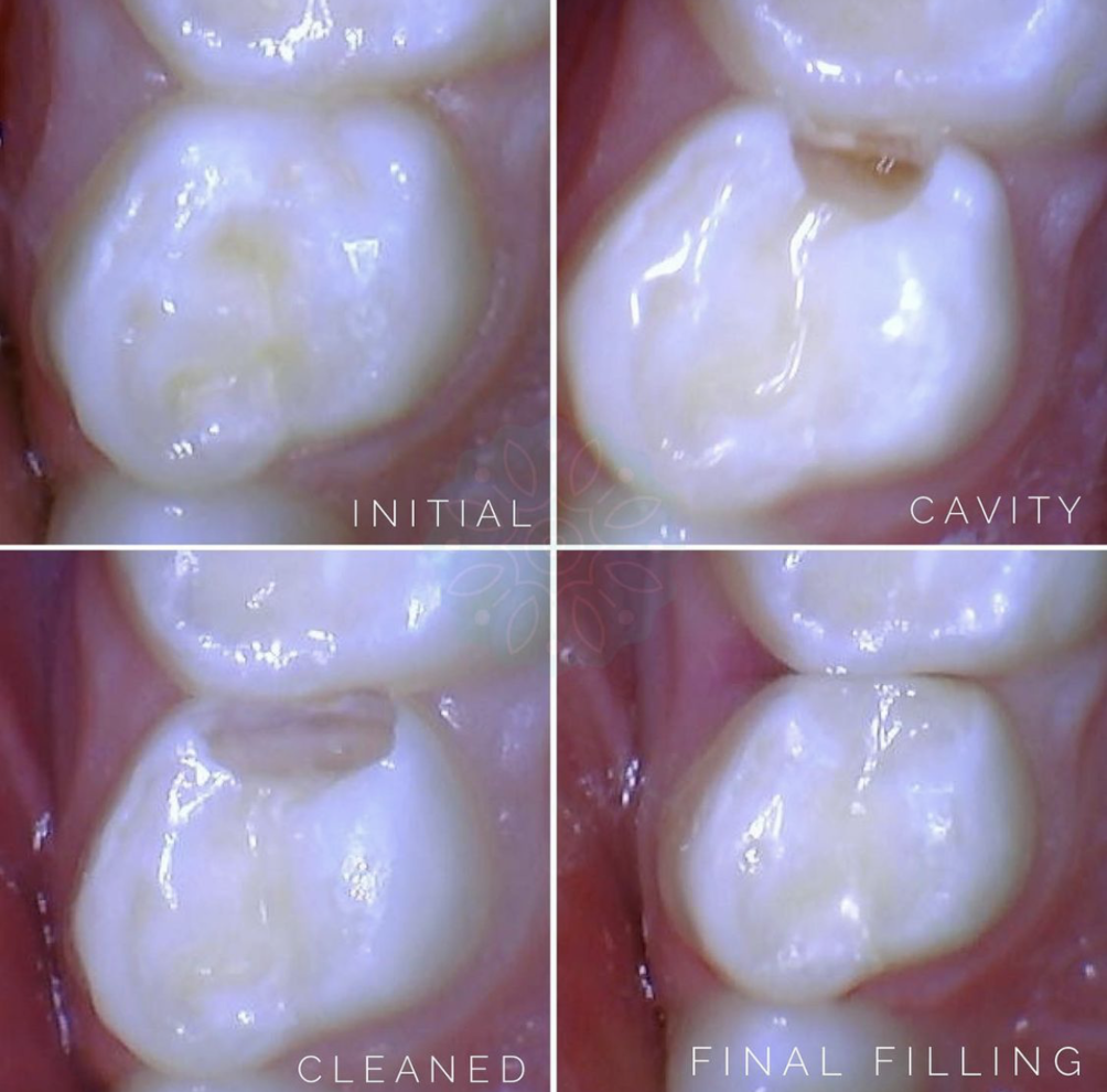 tooth-colored-fillings