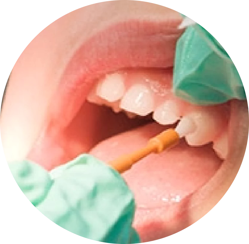 fluoride-for-teeth