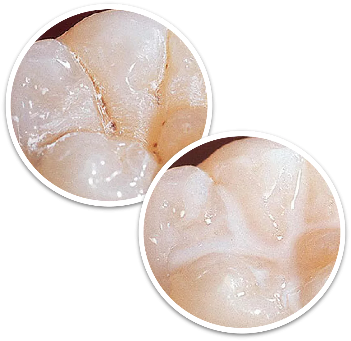 sealants-for-teeth