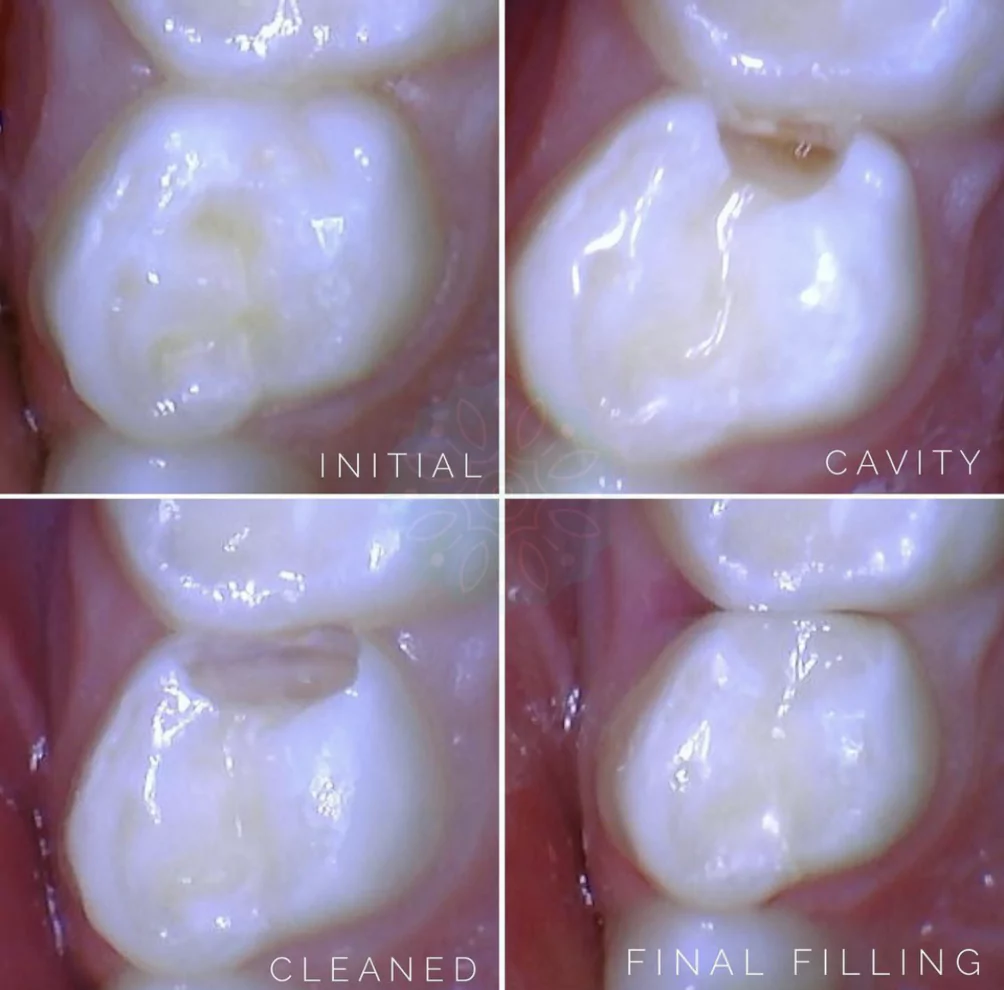 tooth-colored-fillings